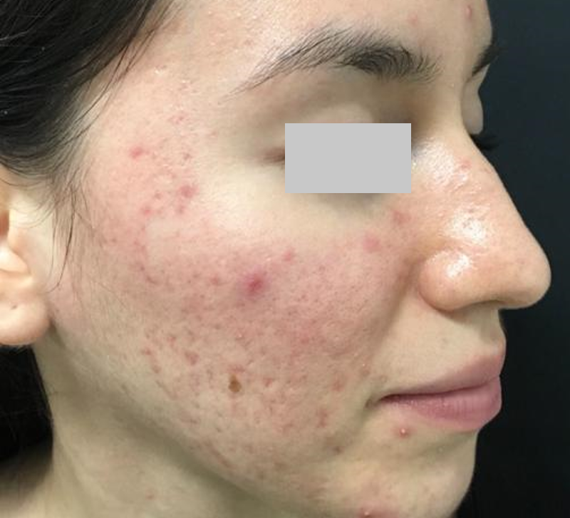 2BEFORE_NORDLYS_ACNE INFLAMMATOIRE