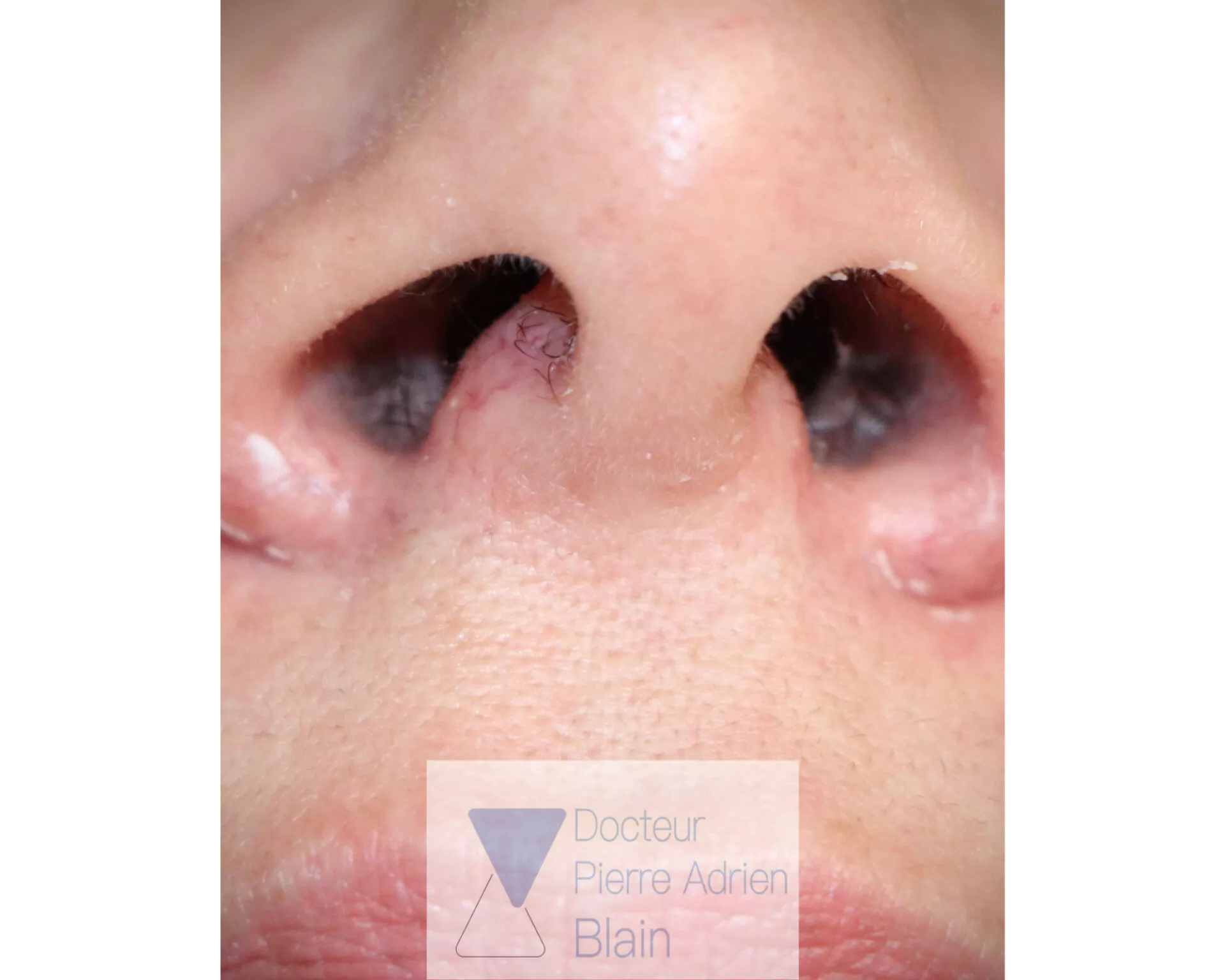 Couperose et Laser Nd : YAG