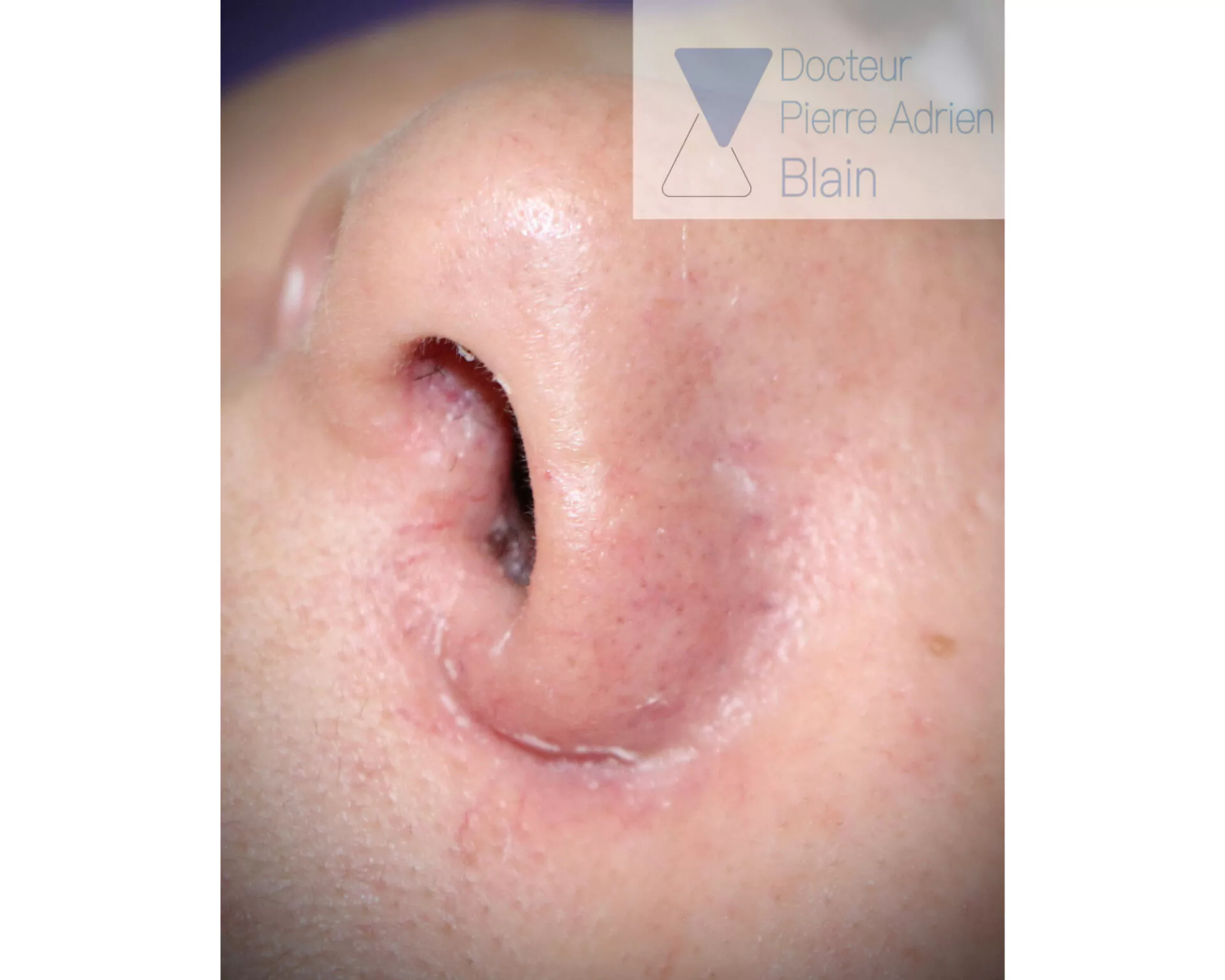 Couperose et Laser Nd : YAG
