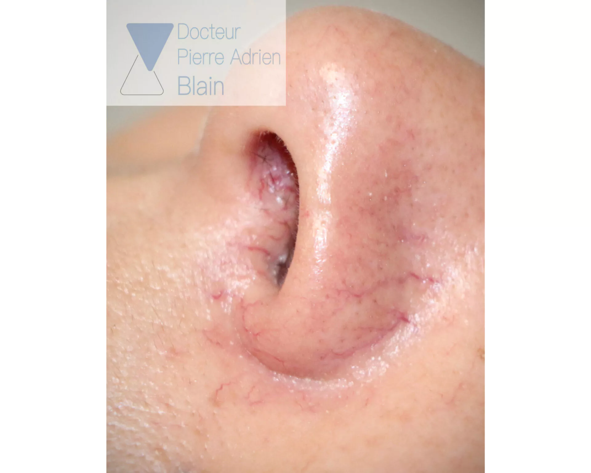 Couperose et Laser Nd : YAG