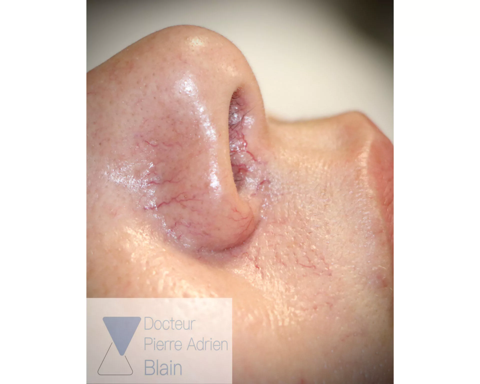 Couperose et Laser Nd : YAG