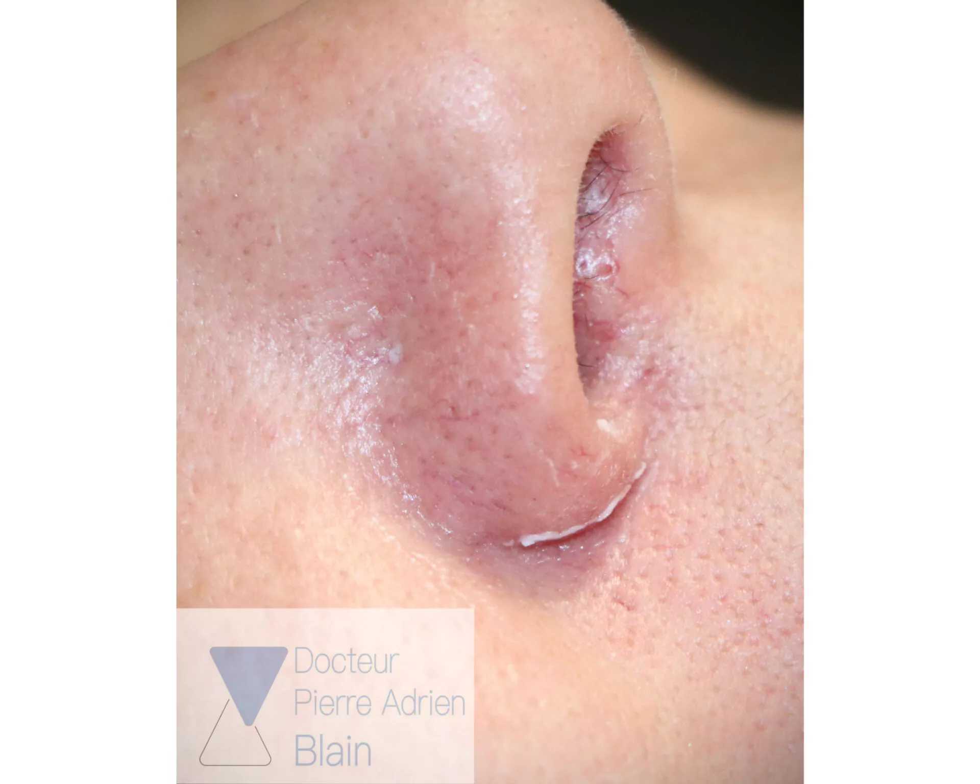 Couperose et Laser Nd : YAG