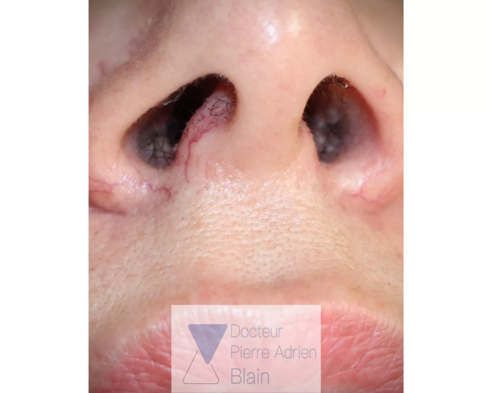 Couperose et Laser Nd : YAG