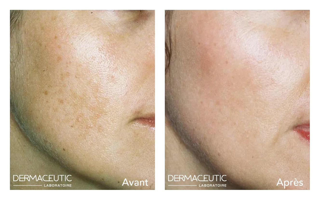DERMACEUTIC-COSMO PEEL (3)